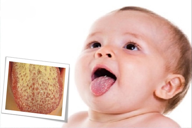 bệnh nấm lưỡi ở trẻ sơ sinh