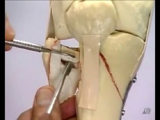 Gãy xương mâm chày - chuẩn đoán và điều trị gãy xương mâm chày hiệu quả
