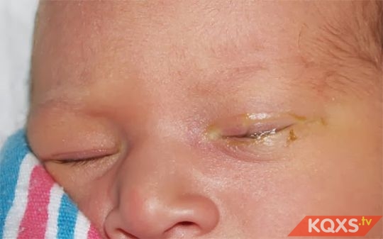 Chảy nước mắt sống nhiều ở trẻ sơ sinh có phải là dấu hiệu tắc nghẽn tuyến lệ không?