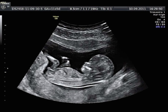 hình siêu âm thai nhi 11 tuần