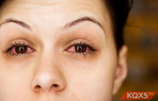 Bệnh khô mắt: Nguyên nhân, biểu hiện và cách xử lý tốt nhất