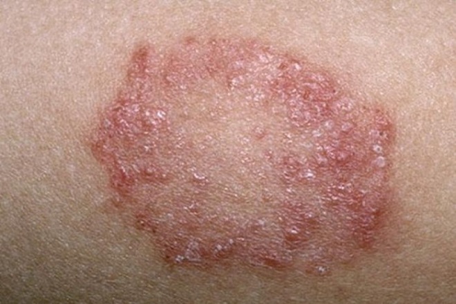Biểu hiện bệnh nấm ngoài da ở trẻ