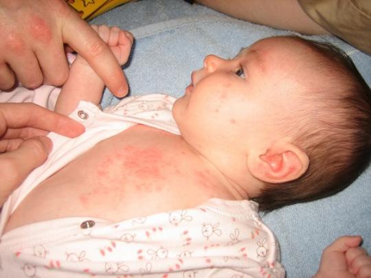 Nguyên nhân gây bệnh rôm sảy ở trẻ em và các bài thuốc điều trị an toàn hiệu quả nhất