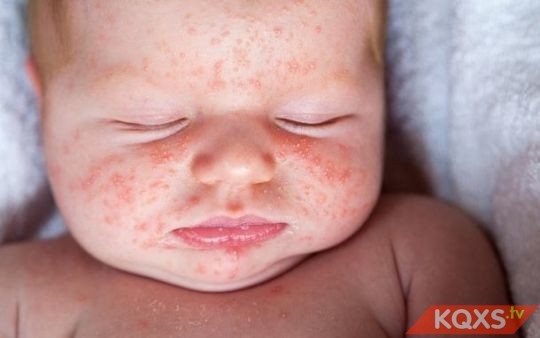Trẻ bị sốt phát ban nhiều lần phải làm sao? Sốt phát ban ở bé biểu hiện thế nào?