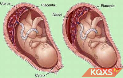Hiện tượng suy thai: Nguyên nhân, dấu hiệu, giải pháp phòng tránh khi mang thai