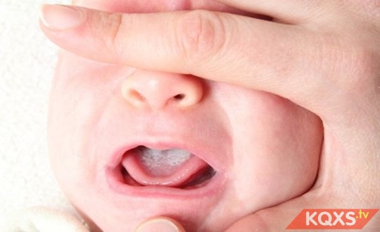 Tưa lưỡi ở trẻ sơ sinh: Nguyên nhân & cách chữa trị tại nhà hiệu quả tốt nhất